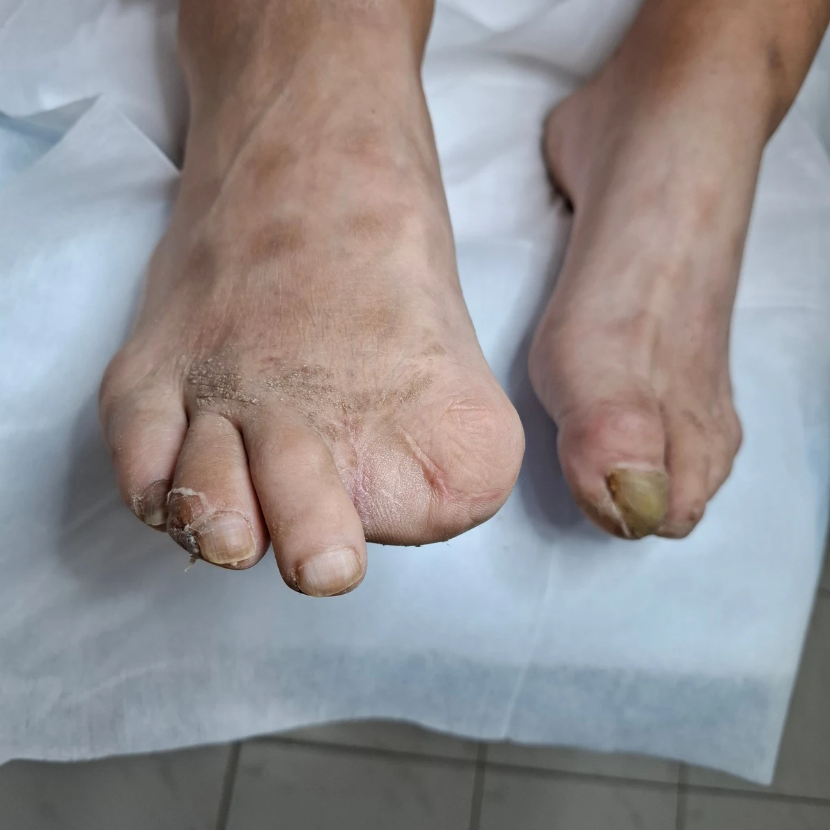 Urasli nokti i korektivne kopče